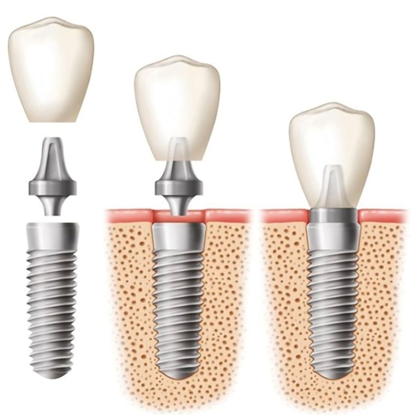 implant-dentar-1